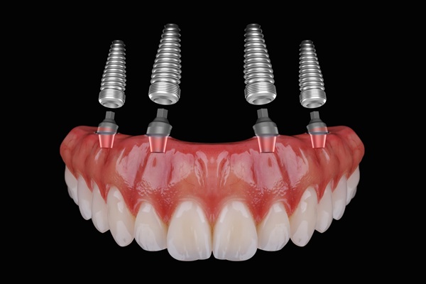 Facts You Need To Know About All On   Implants