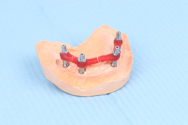Mini Dental Implants Vs  Standard Implants: Key Differences To Know